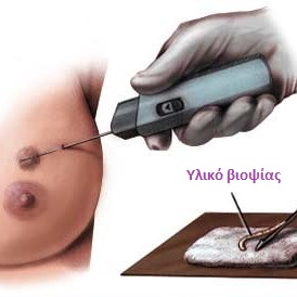 Βιοψία με κόπτουσα βελόνα