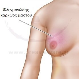 Ε5γ_Φλεγμονώδης(1)